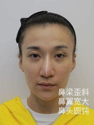 鼻樑起節女面相|女人鼻樑有節不利感情？如何有效化解面相？用醫美打造美鼻線條。